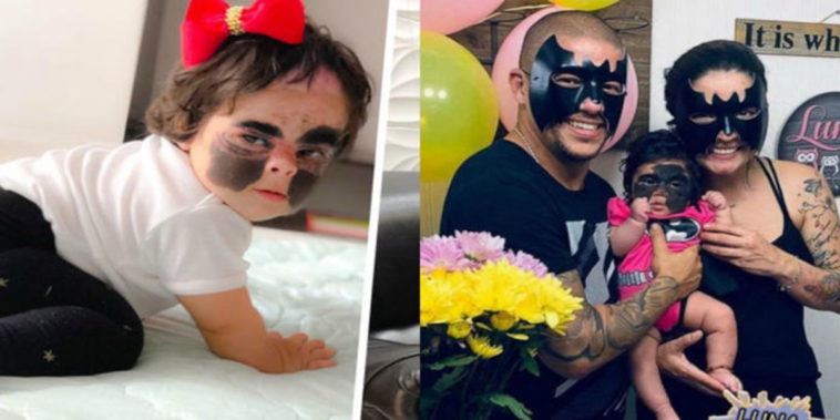 Luna Fenner nicknamed "The Batbaby" for having a birthmark resembling Batman