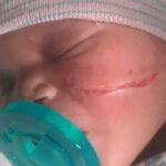 Newborn baby girl suffers a cut on her face from cesarean section