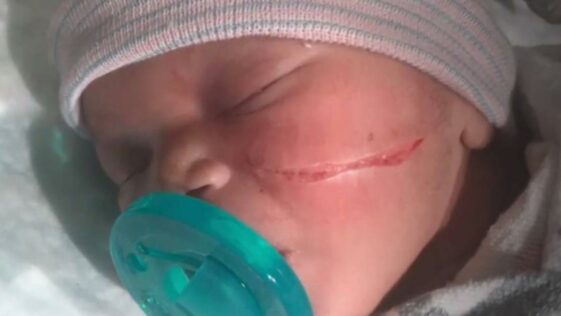 Newborn baby girl suffers a cut on her face from cesarean section