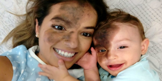 He paints his face the same as his son's birthmark to support him