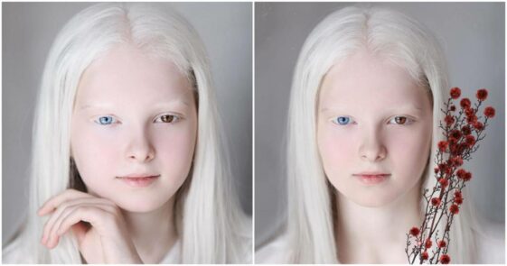 Albinism and heterochromia conjugated in the same person cause unusual beauty