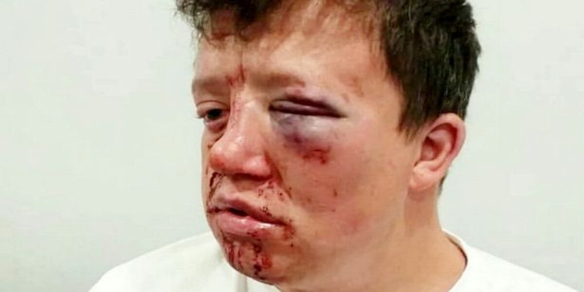 Disabled soccer fan suffers terrifying facial injuries in 'brutal attack'