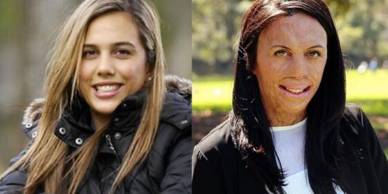 Turia Pitt, from surviving a fire to the cover of a magazine